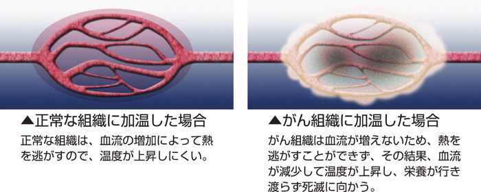 がん温熱療法