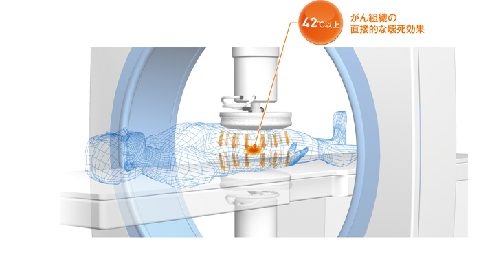 がん温熱療法