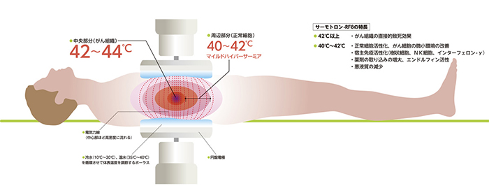 がん温熱療法