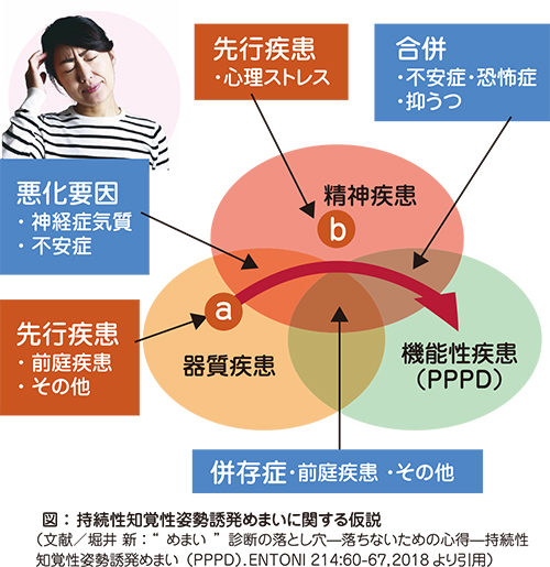 持続性知覚性姿勢誘発めまい