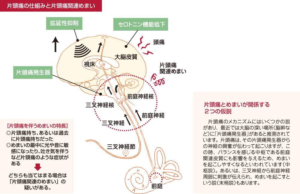 片頭痛関連めまい